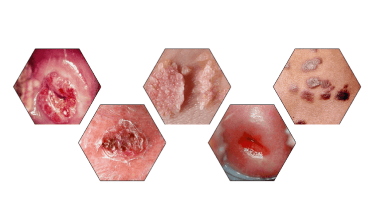 Zakaj so papilomi nevarni