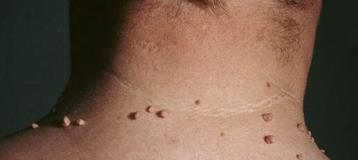 kako se znebiti papiloma