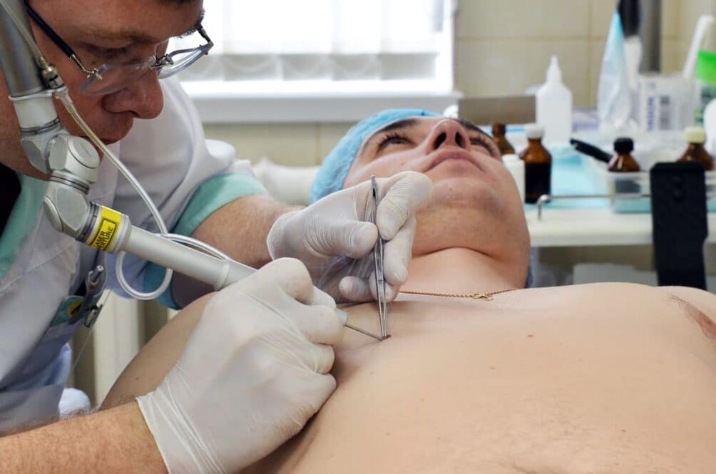 kako se znebiti bradavic na telesu