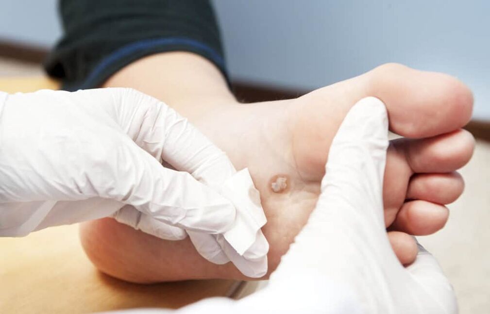 zakaj se na telesu pojavijo bradavice