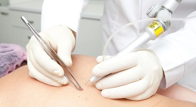 lasersko odstranjevanje papiloma za papiloma virus