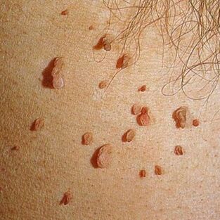 Papilomi pogosto rastejo v kolonijah in se lahko pojavijo na koži celega telesa